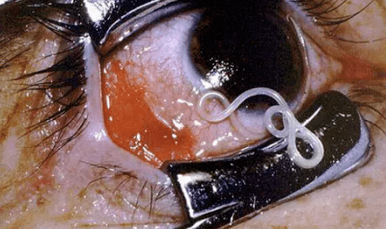 Typy parazitov v ľudskom tele